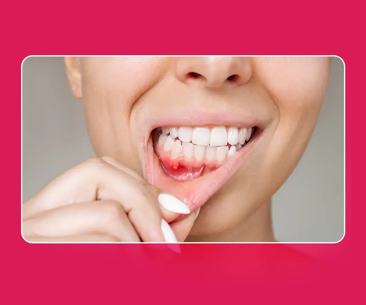 Gum Treatment in Gurgaon